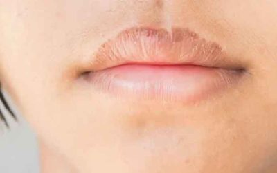 বারবার ঠোঁট ফাটছে? মেনে চলুন ঘরোয়া উপায়